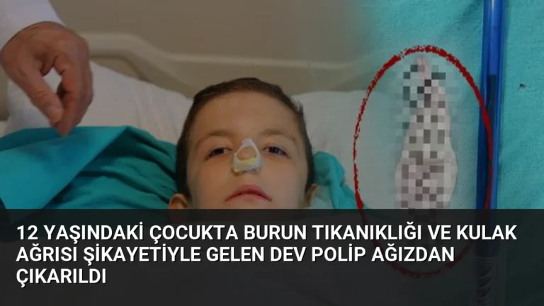 12 Yaşındaki Çocukta Burun Tıkanıklığı ve Kulak Ağrısı Şikayetiyle Gelen Dev Polip Ağızdan Çıkarıldı