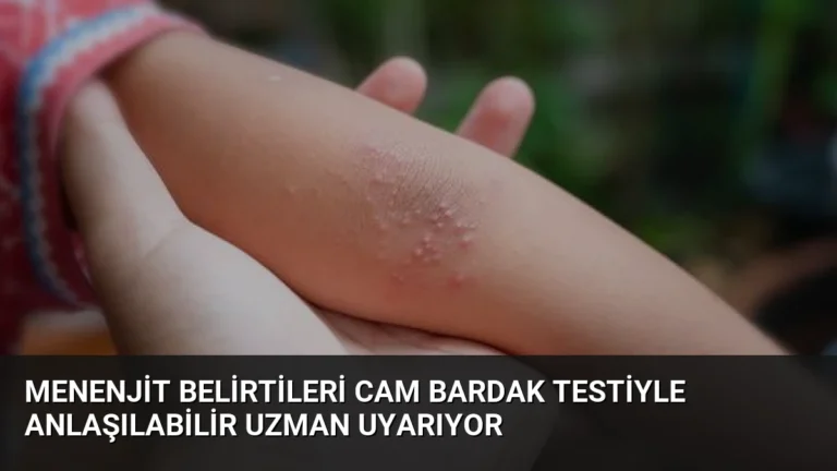 Menenjit Belirtileri Cam Bardak Testiyle Anlaşılabilir Uzman Uyarıyor